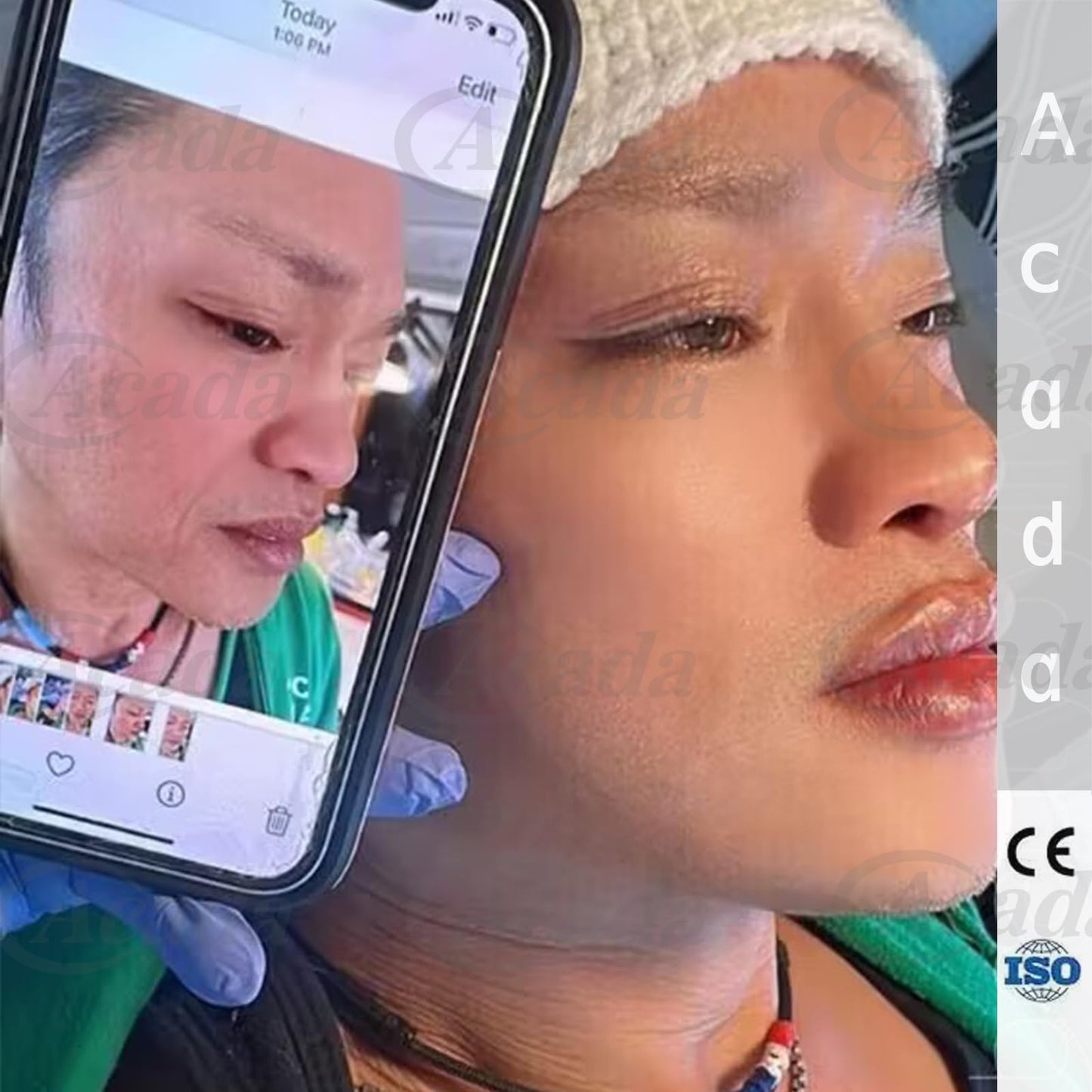 PCL Multi Threads for Face Lift, Filling of Sunken Areas, Wrinkle Care 23G38mm Blunt L-Type - 20Pcs