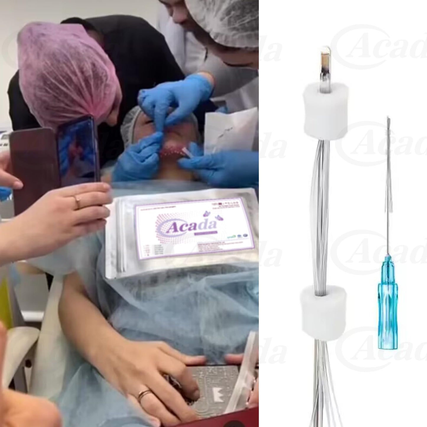 PCL Multi Threads for Face Lift, Filling of Sunken Areas, Wrinkle Care 23G38mm Blunt L-Type - 20Pcs