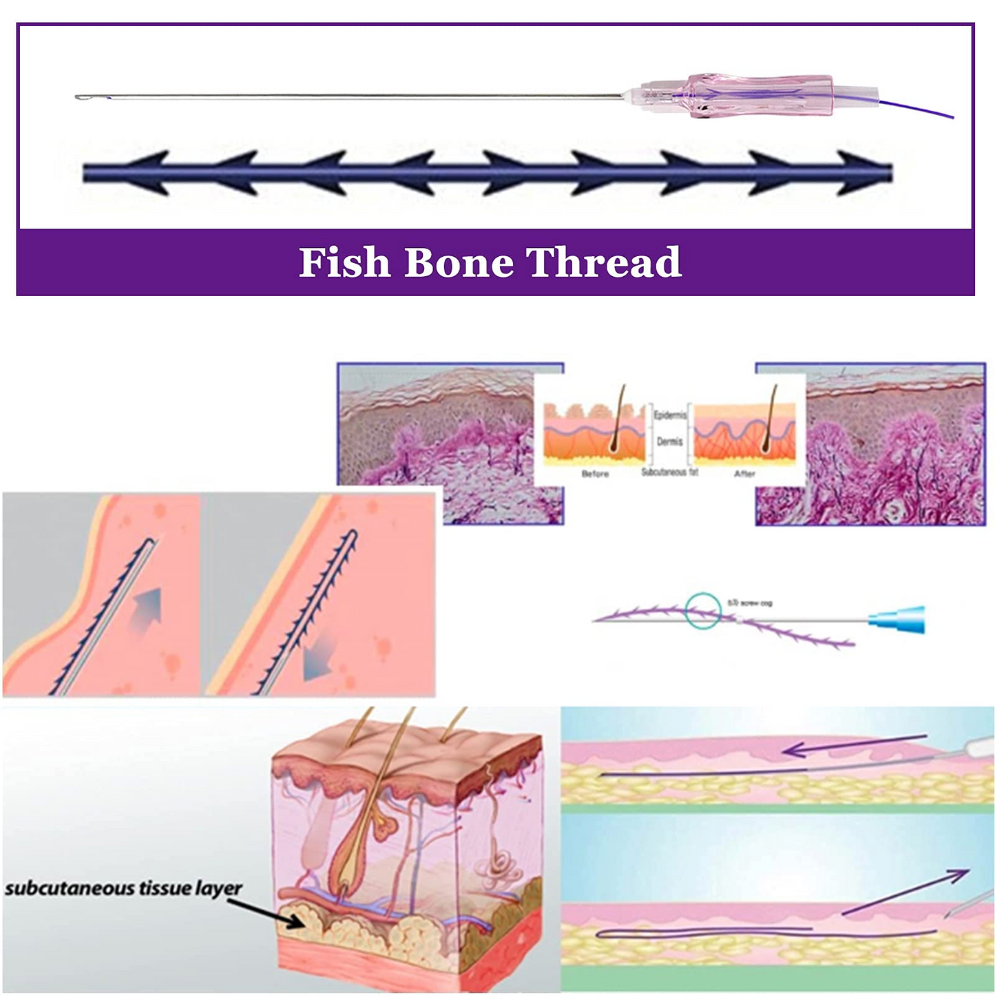 PDO Thread Fishbone Line Molding Cog PDO Thread 18G-100mm 20pcs